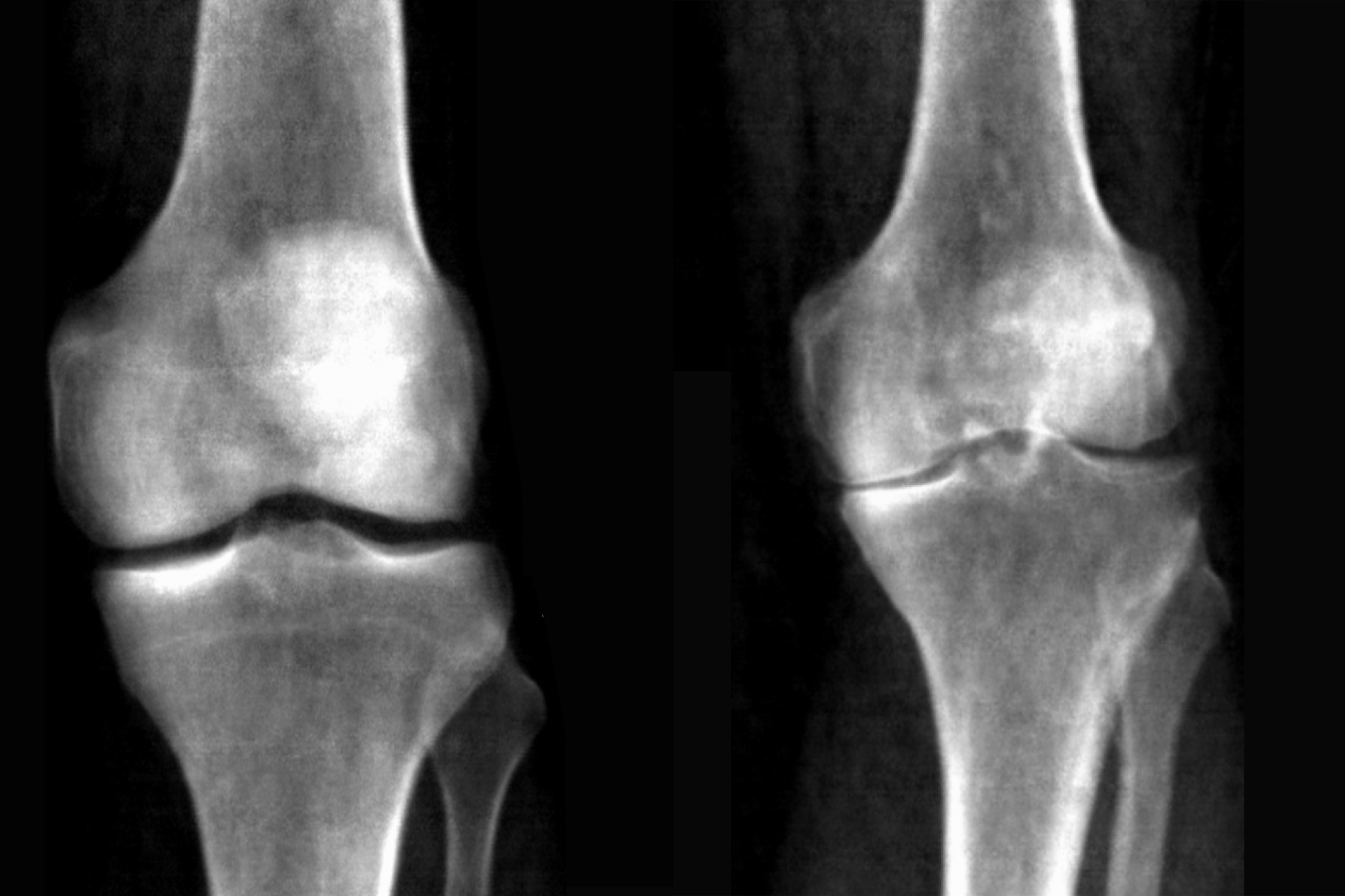 Two x-rays of knees